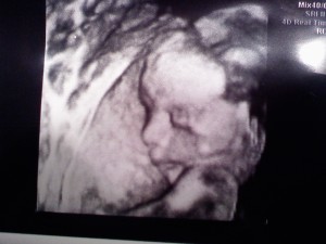 3D ultra sound