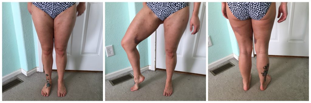 fat grafting thigh week 2