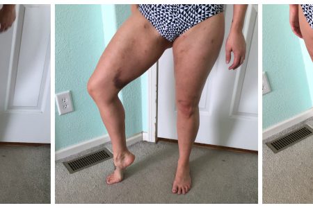 fat grafting thigh week 2