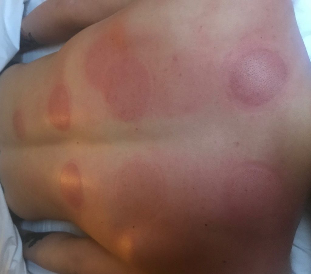 PW after cupping