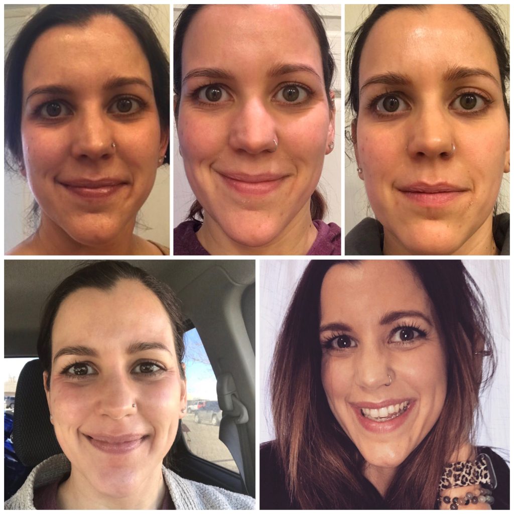 chemical peel collage