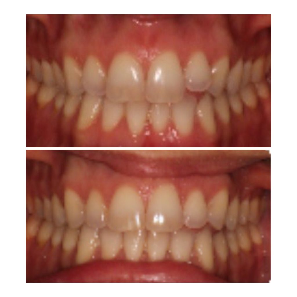 Smile My Before And After Pictures From Clear Aligners Prairiewifeinheels Com